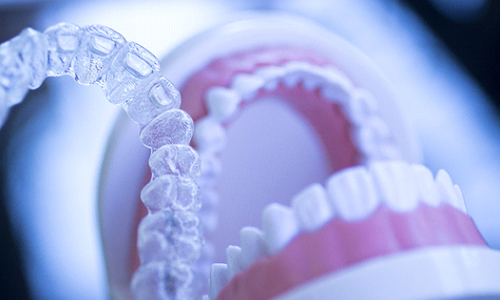 Invisalign Clear Braces - Courthouse Dental & Implants