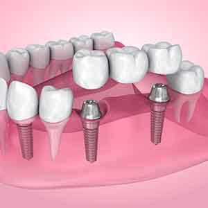 a computer illustration of two implant crowns