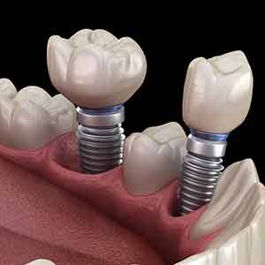 a computer illustration of an implant bridge