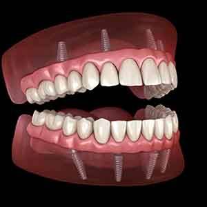 a computer illustration of implant dentures