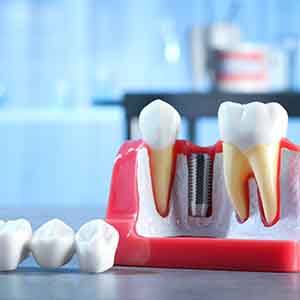 a model of two teeth between a dental implant